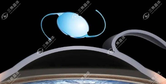 博士伦人工晶体是国产还是进口?美国进口晶体/能用20年左右