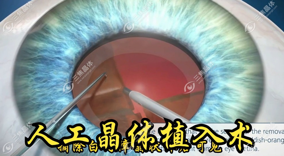 博士伦人工晶体是国产还是进口?进口