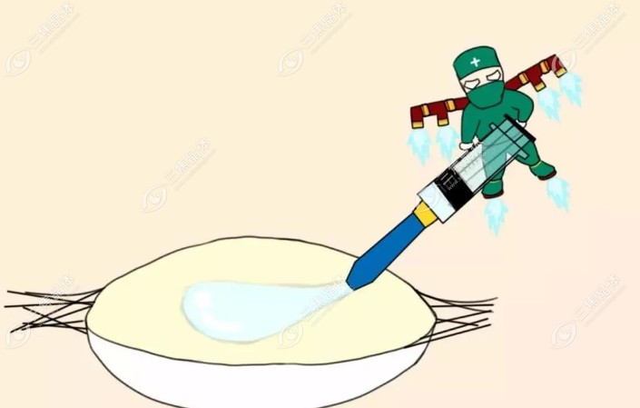 icl手术后不是永远不能揉眼