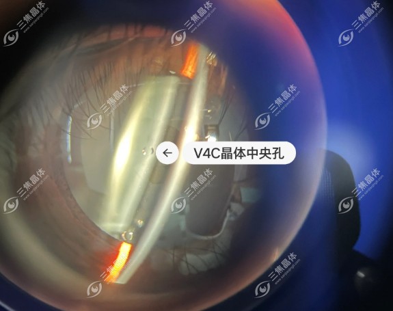 角膜有疤痕能做icl晶体植入
