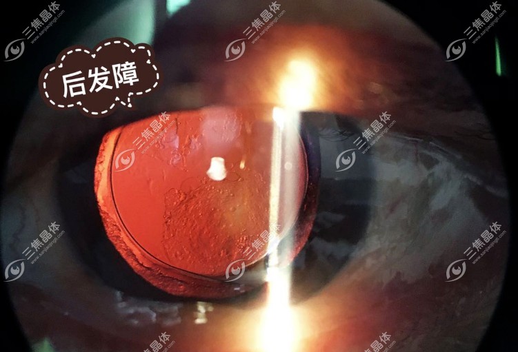 后发障激光后有漂浮物几天会消失?正常情况下7-15天就会消失