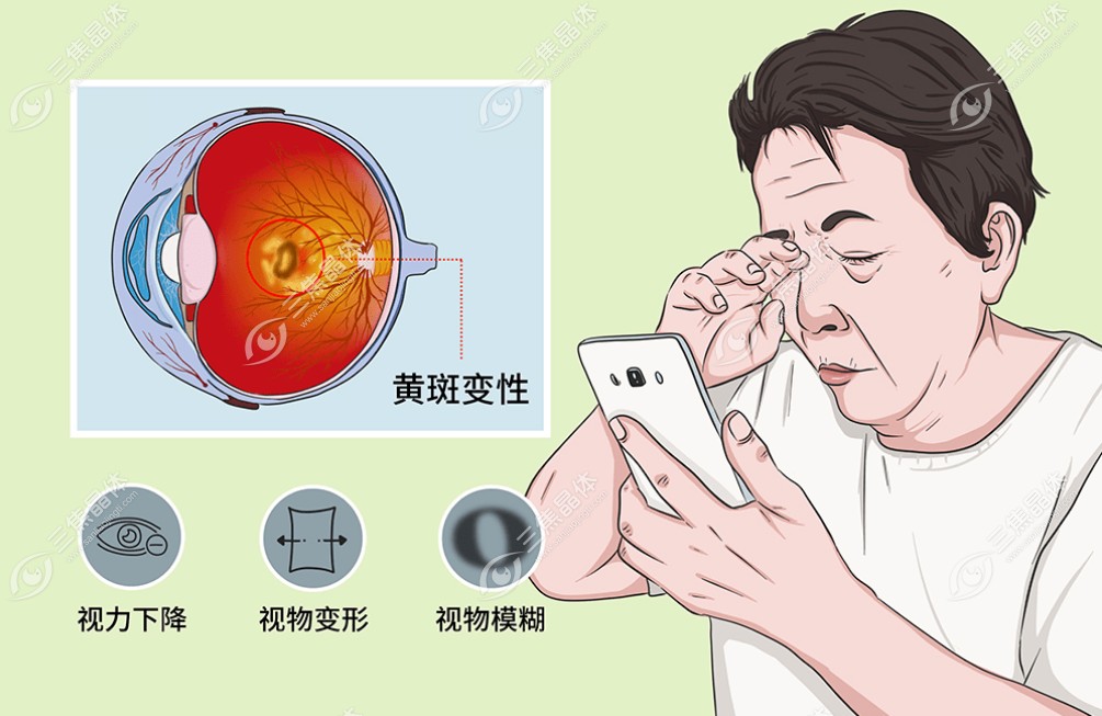 哪些人工晶体能保护黄斑膜www.sanjiaojingti.com