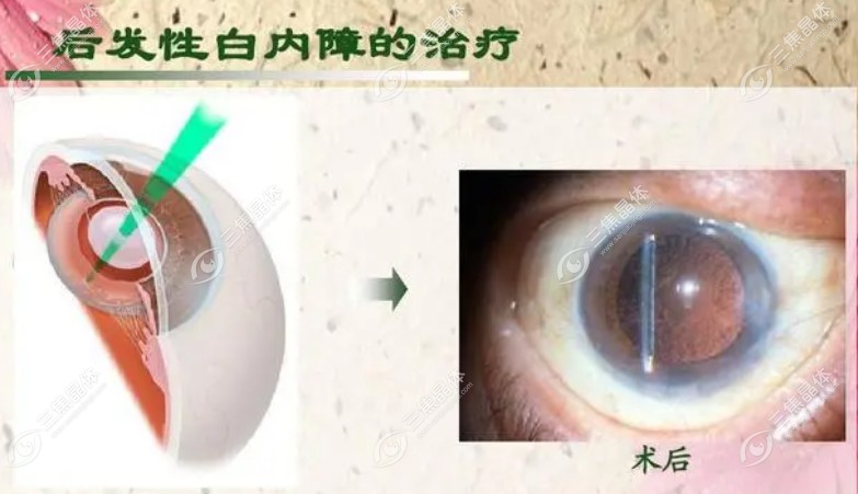 后发障激光后有漂浮物几天会消失?7-15天左右