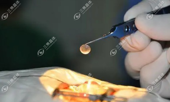 合肥角膜移植哪家医院好?普瑞/名人/东南眼科做角膜移植好