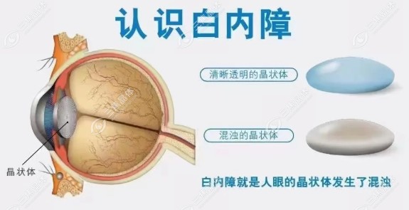 两只眼睛能装不同的晶体