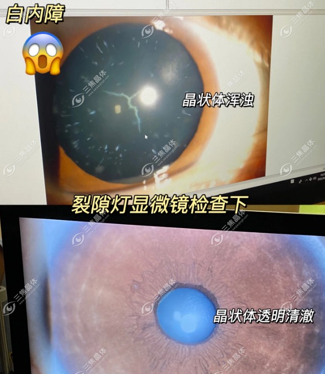 可以一只眼单焦一只眼多焦