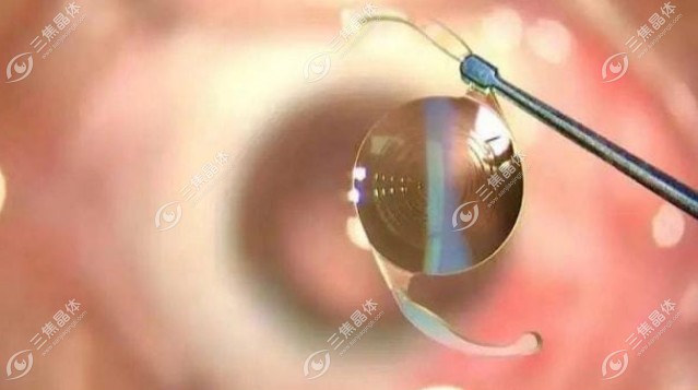 白内障晶体价格高低，术后视觉质量不同