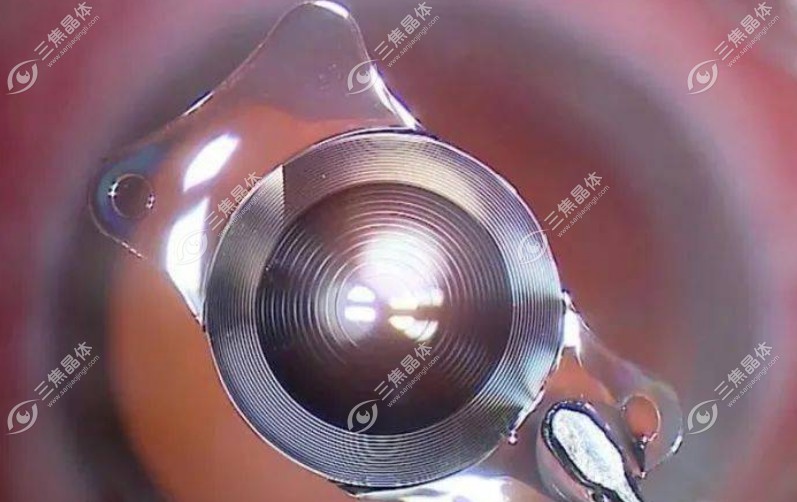 toric人工晶体特点