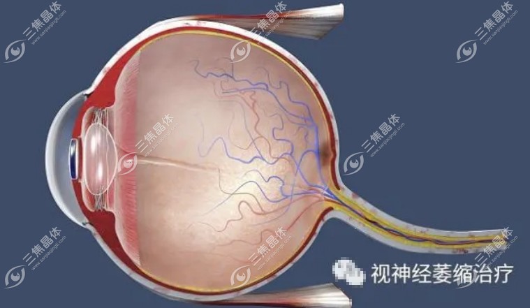 虽然视网膜神经萎缩可以治，但不能完全治好。