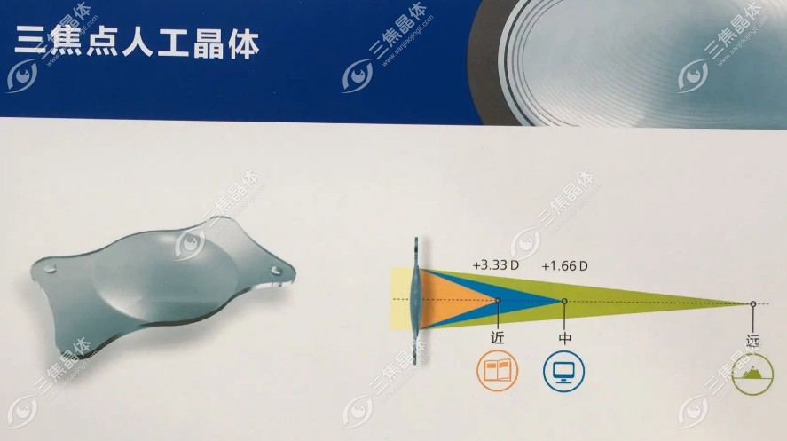 三焦晶体植入的总费用在4-5万左右(含检查/手术/晶体/复查费)