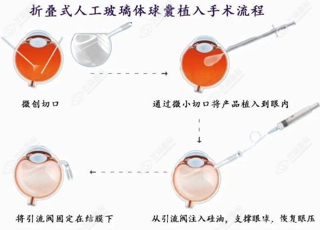 眼内注油+玻璃体植入手术