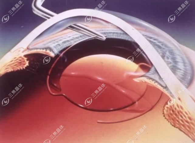 散光矫正型人工晶状体www.sanjiaojingti.com