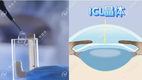 icl晶体植入十年后的危害