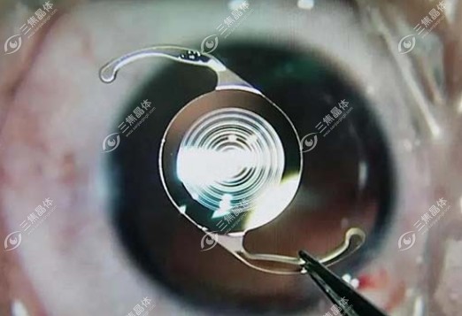 人工晶体度数选择原则二：眼轴长度