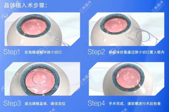 罗岩icl价格35990元起