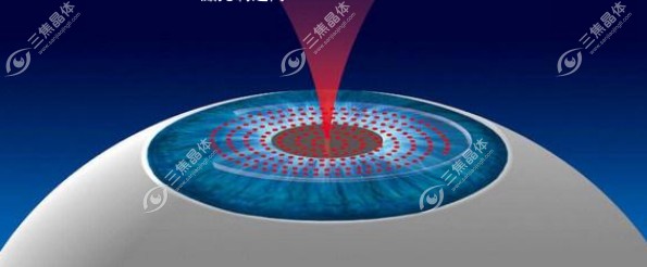 邢台爱尔眼科医院怎么预约~三焦晶体