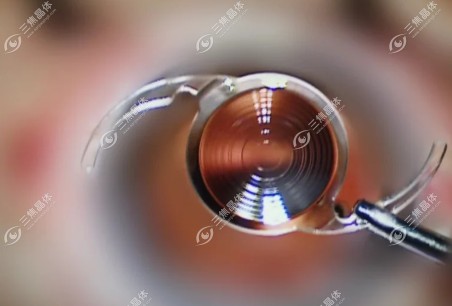 爱尔康三焦点人工晶体使用感受