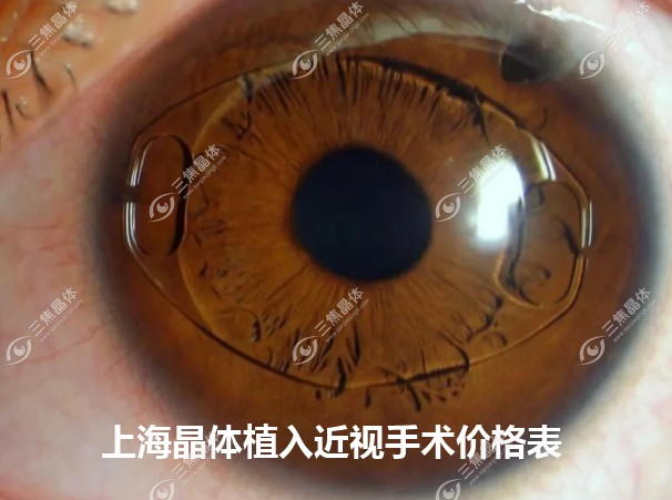 上海晶体植入近视手术价格32000元起#sanjiaojingti