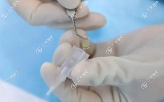 新无极晶体术后感觉