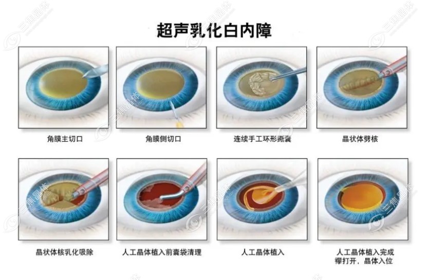 吉林市北华朝日眼科医院白内障