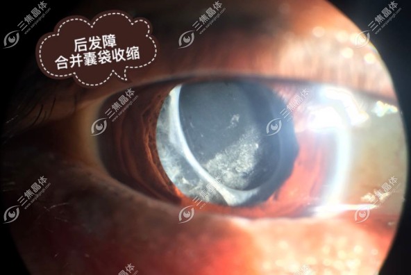 后发障激光后还会再复发吗?一般不会