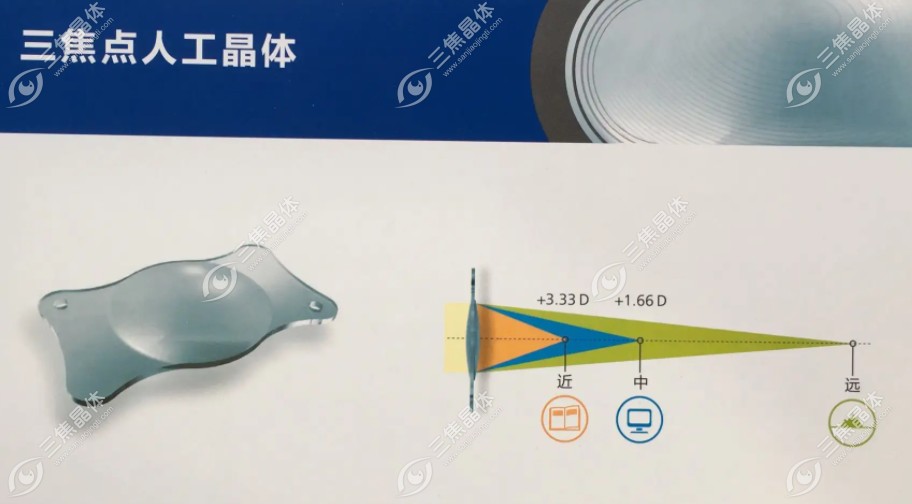 爱尔康三焦晶体植入后看远清楚,看近模糊且有光圈基本上1-3个月左右就会改善