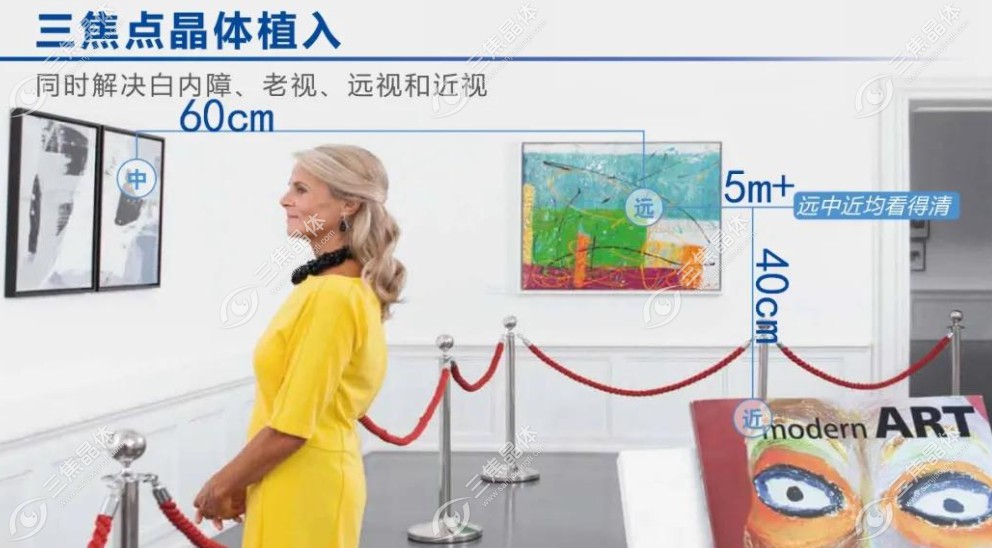 爱尔康人工晶体集采价格