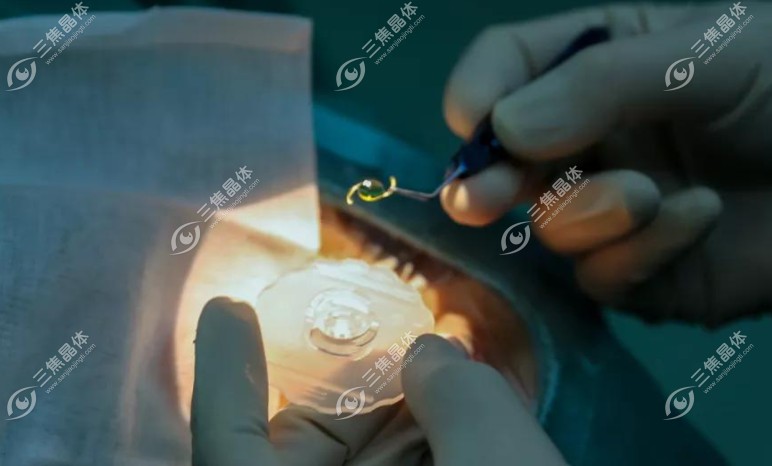 美国爱尔康三焦晶体的市场展望