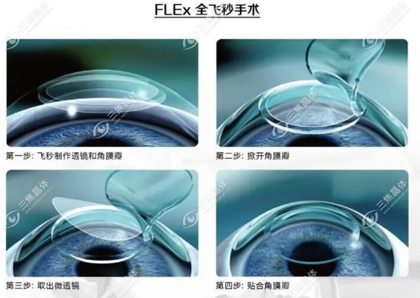 为什么医生不建议用全飞秒？可能您更适合其他手术方式哦