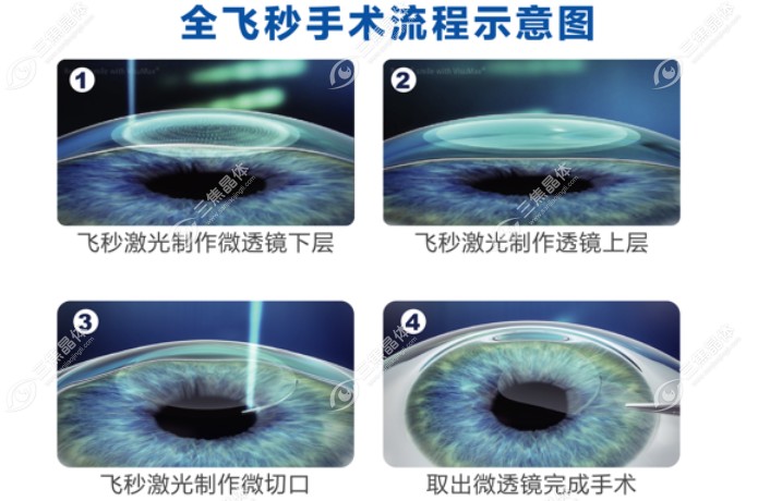 全飞秒手术后5年亲身经历分享