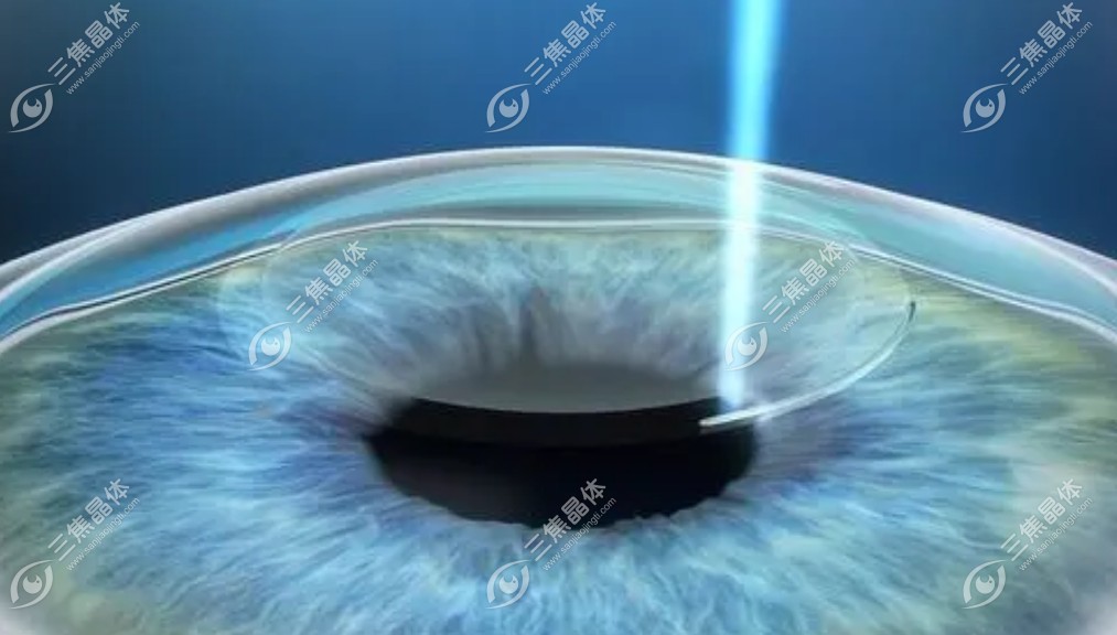 眼角膜形状不好做飞秒激光的注意事项