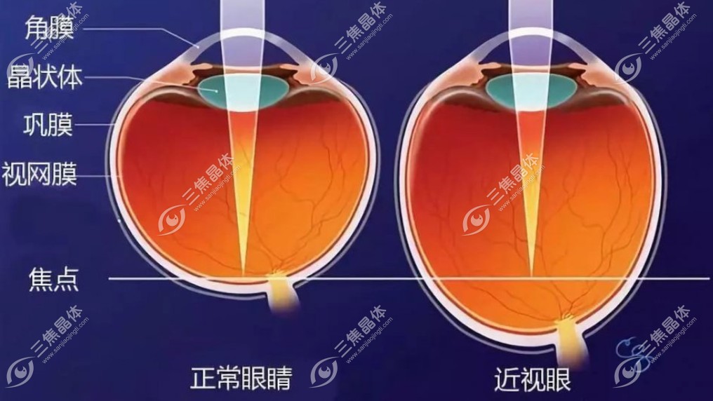 近视眼从800度降到100度?宝子长点心吧！别再被伪科普误导了~
