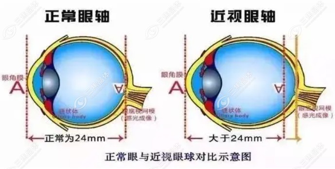近视眼从800度降到100度不可能