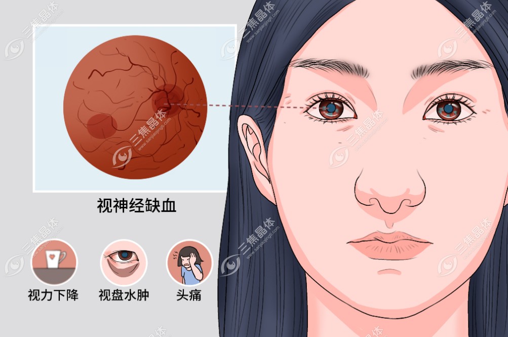 视神经缺血性神经病变www.sanjiaojingti.com