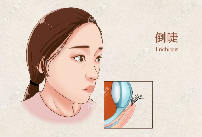 下睫毛倒睫
