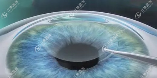 全飞秒激光近视手术