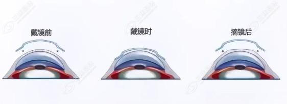 角膜塑形镜(ok镜)