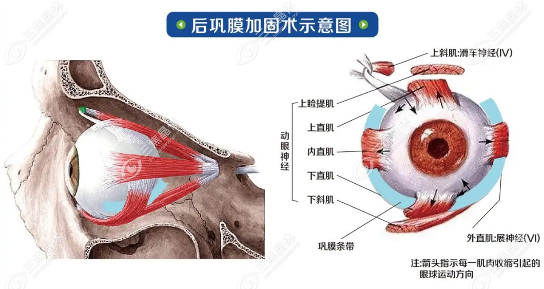 后巩膜加固术