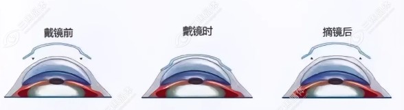 昆明大全眼科医院角膜塑形镜价格