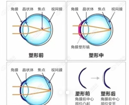 昆明大全眼科医院角膜塑形镜价格