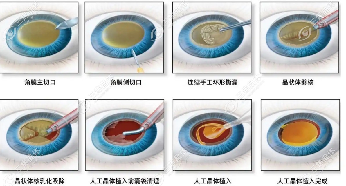 昆明白内障手术费多少钱