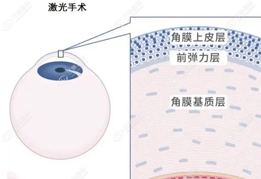 河北邢台眼科近视手术多少钱