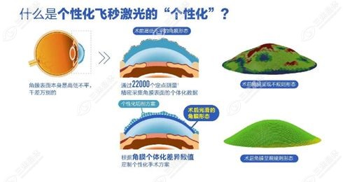 邯郸近视矫正技术详解与选择建议