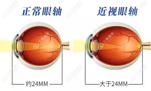 爱尔眼科做后巩膜加固手术技术成熟吗