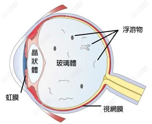 后巩膜加固术5年以后的成效怎么样