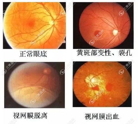 后巩膜加固术5年以后的成效