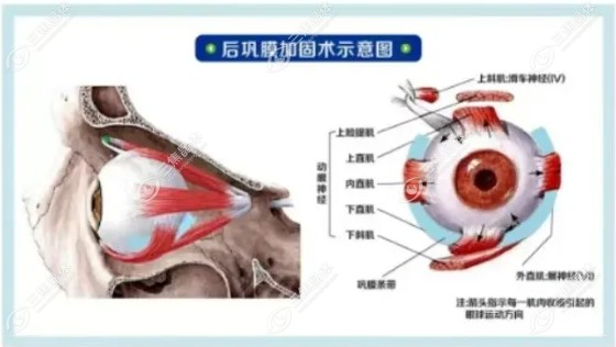 后巩膜加固术4万不贵