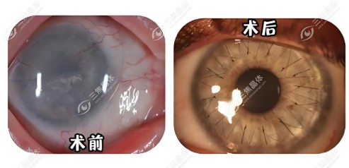 换角膜