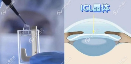 ICL晶体植入