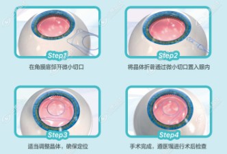 icl晶体植入手术